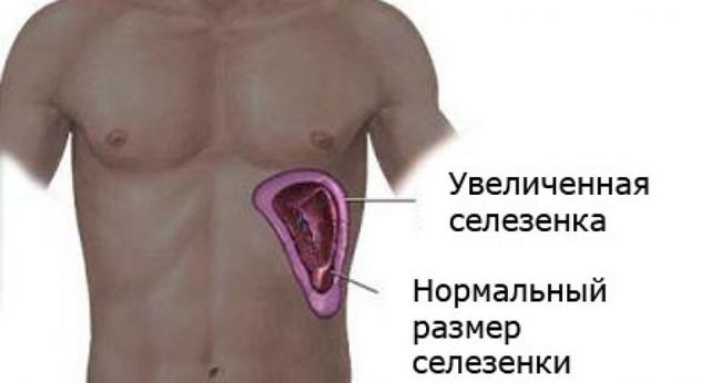 Проблемы с селезенкой могут стать причиной болей в левом боку