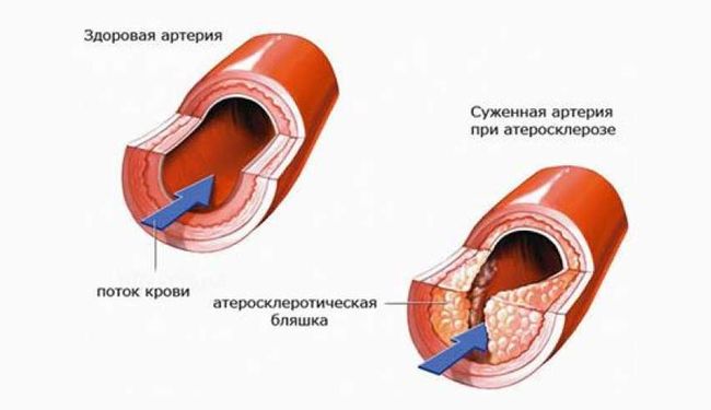 При гипертонии следует не забывать о чистке сосудов