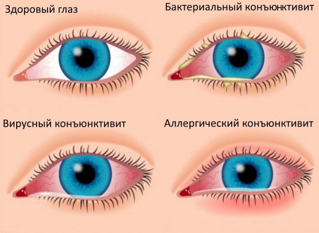 Классификация: взрослый бактериальный конъюнктивит, хламидийный конъюнктивит, грибковый конъюнктивит, аллергический конъюнктивит