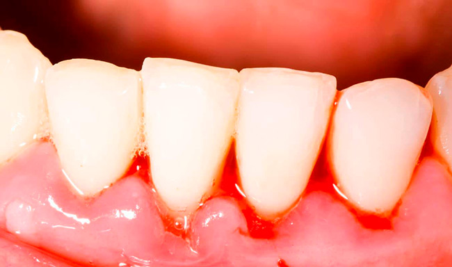 Кровоточивость десен необходимо лечить сразу при первых проявлениях, чтобы избежать развития сопутствующих стоматологических заболеваний