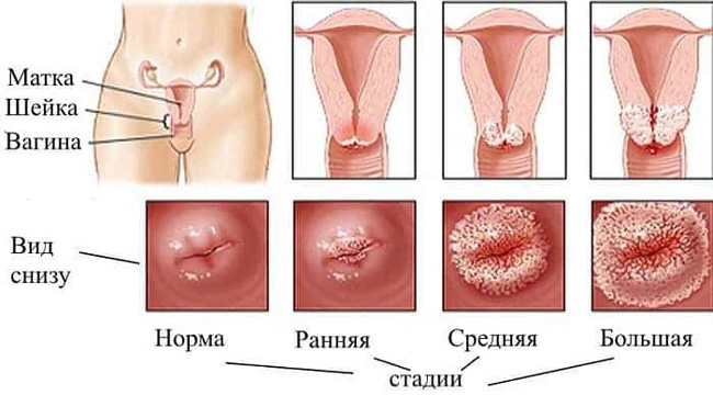 По степени структурных изменений тканей и глубины проникновения атипичных клеток в эпителий, различают три стадии дисплазии шейки матки