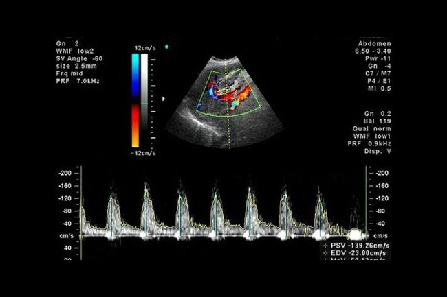 Ультразвуковая диагностика, которая показывает кровообращение плода называется допплерография.
