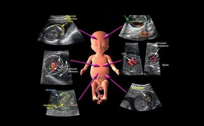 С помощью дуплексного сканирования изучается функциональное состояние сосудов ребенка и их проходимость.