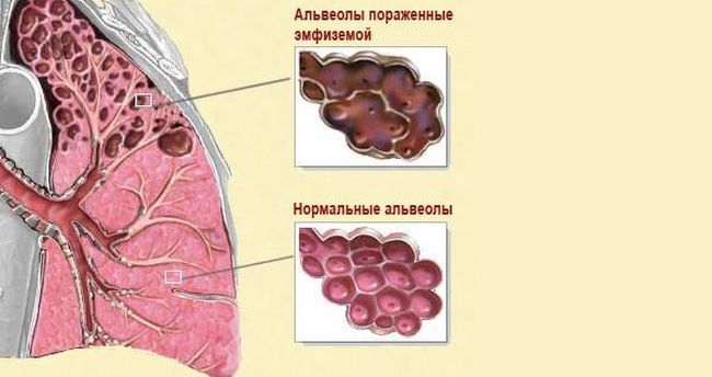 Эмфизема легких встречается всего у 5% пациентов.