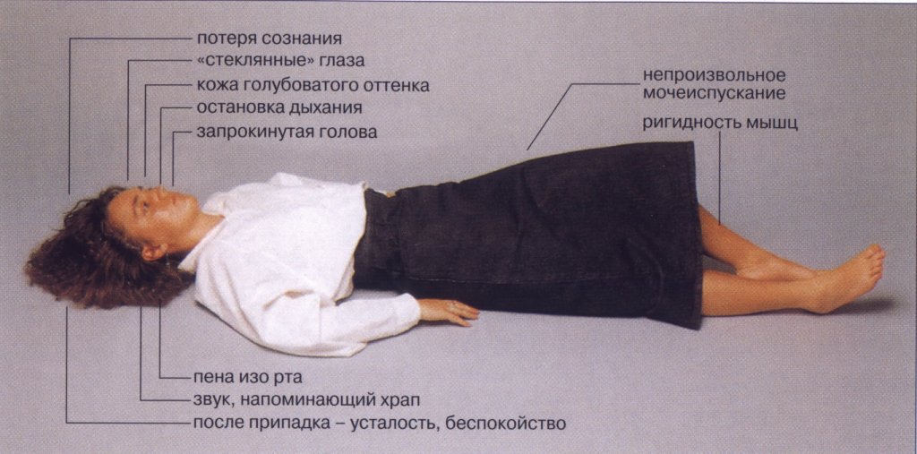 У эпилепсии весьма выраженные признаки, поэтому даже неопытному человеку не составит труда определить заболевание.