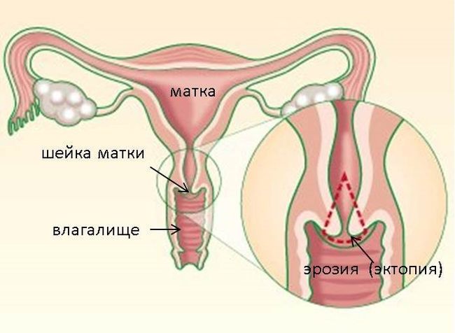 Эрозия шейки матки - это патология, которую обнаруживают у 30% женщин при осмотре.