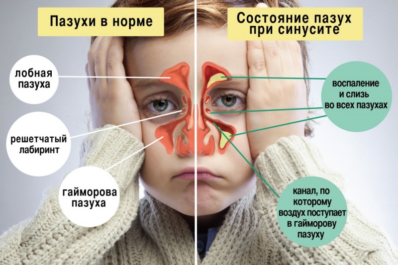 На этой картинке наглядно показано главные симптомы гайморита, ознакомьтесь, пожалуйста, с ними