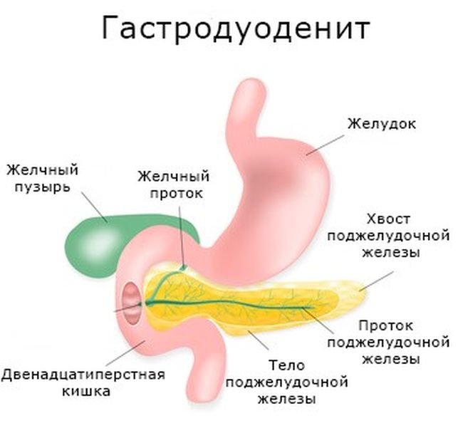 Гастродуоденит у взрослых – это наиболее часто встречающееся заболевание желудочно-кишечного тракта