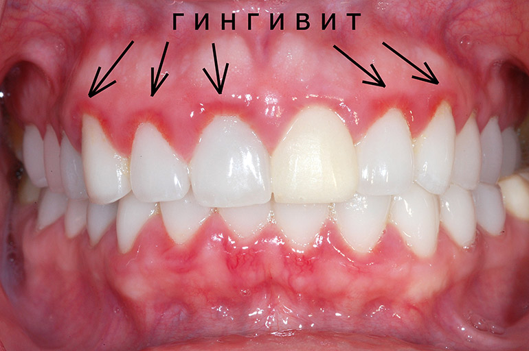 Гексализ - эффективное средство для лечения гингивита