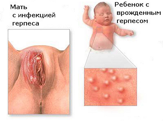 Герпес на половых губах, может быть опасен для здоровья