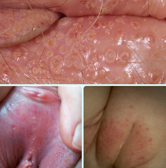  Так выглядит герпес на половых губах