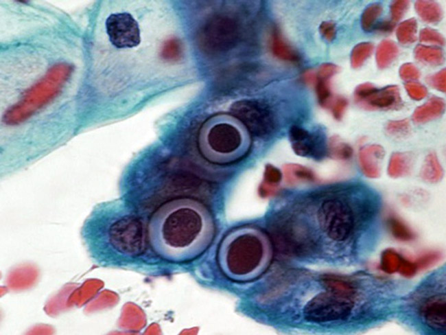 Chlamydia - возбудитель группы патологий под общим названием хламидиоз