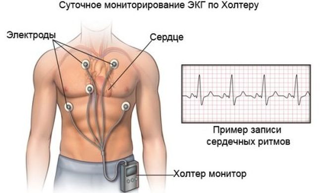 Мониторинг ЭКГ по Холтеру.