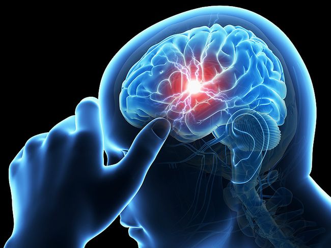 В результате инсульта кровообращение мозга резко нарушается, что ведет к гибели и отмиранию нервных клеток