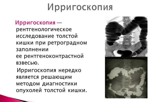 Ирригоскопия кишечника - одна из самых простых, безболезненных и популярных обследований толстой кишки.