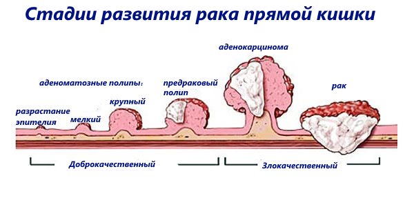 На фото показаны стадии развития рака прямой кишки, грань между доброкачественной и злокачественной опухолью. Так аденоматозные полипы развиваются в аденокарциному и рак.