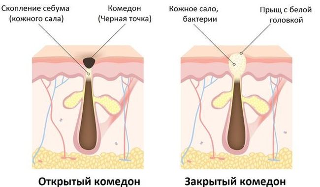 Открытый и закрытый комедоны