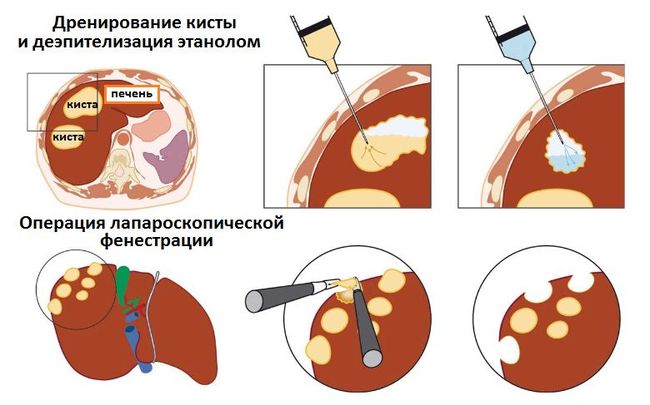 На фото показано как проходит операция по удалению кисты из печени.
