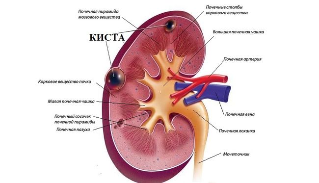 Как выглядит киста почки