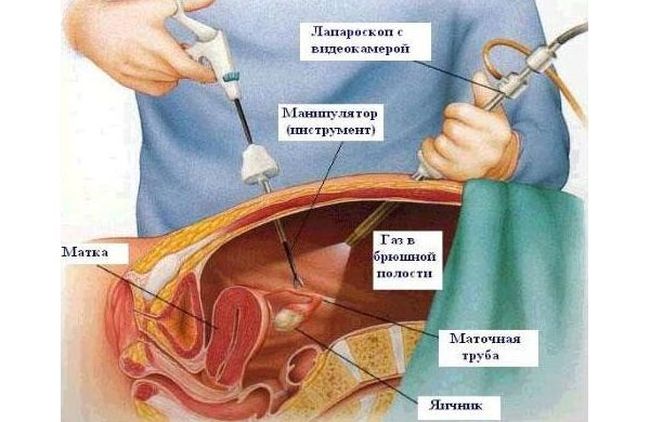 Как именно необходимо лечить кисту яичника может определить только специалист