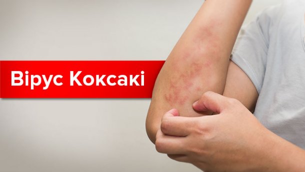 Вирус Коксаки - это нашумевший в 2017 году тип энтеровирусов. Что нужно знать о нем и как следует лечить болезнь, вы узнаете в этой статье