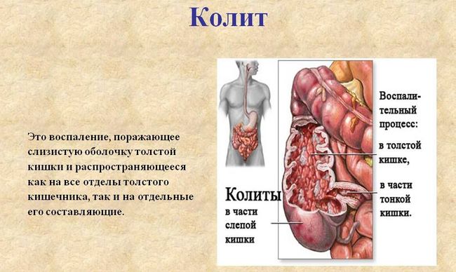 Симптомы колита кишечника могут отличаться в зависимости от того, в острой или хронической стадии находится болезнь