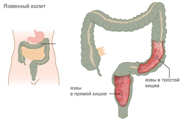 Язвенный колит кишечника относится к хроническим заболеваниям