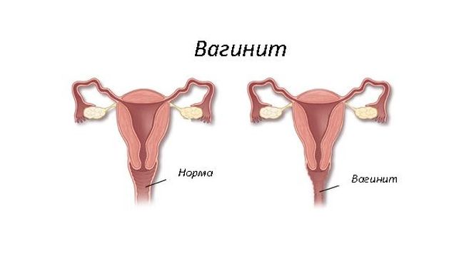 Проявление вагинита