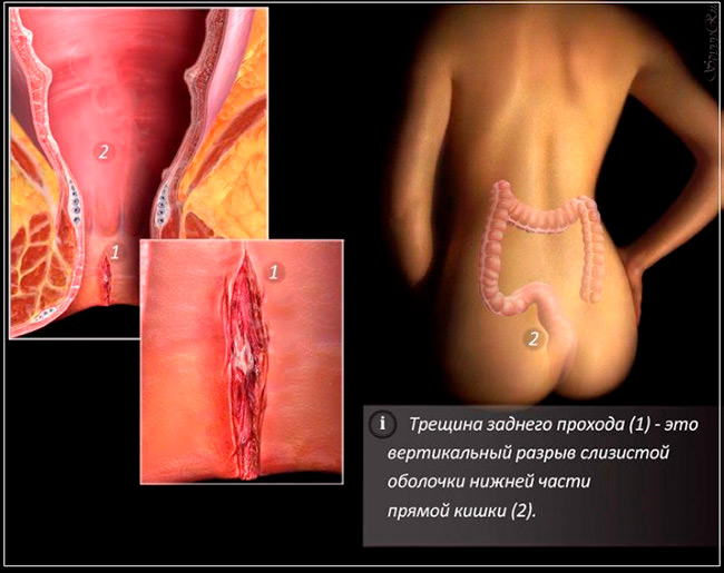 У больных анальной трещиной важное значение имеет нормализация стула, для чего назначаются мягкие слабительные, а также диета, исключающая острые блюда, копчености, обилие приправ, алкоголь и кофе