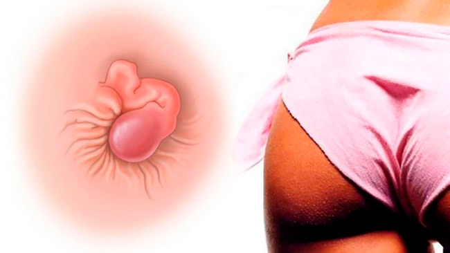 Объем выделяемой крови при геморрое зависит от степени заболевания и особенностей его проявления, однако на поздних этапах кровотечение может быть сильно выраженным, приводить к анемии, ухудшению общего состояния