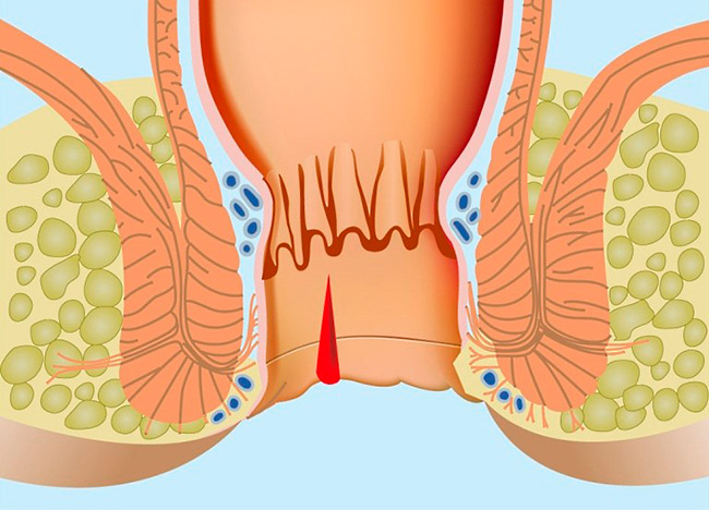 Кровь при стуле может указывать на множество заболеваний и патологий, начиная от трещин слизистой и заканчивая раком кишечника, лейкозом и иными угрожающими жизни болезнями