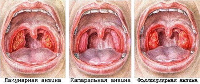 Основные виды ангины:герпетическая ангина, фолликулярная ангина, катаральный тонзиллит, Лакунарная ангина