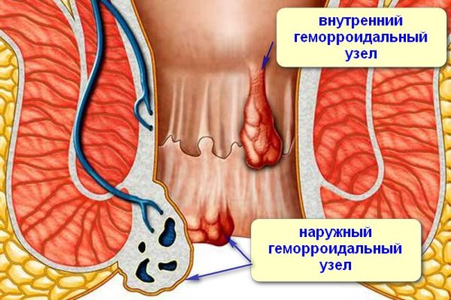 Внутренний и наружный геморроидальные узлы