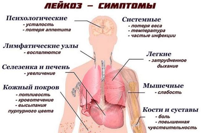 Основные симптомы лейкоза