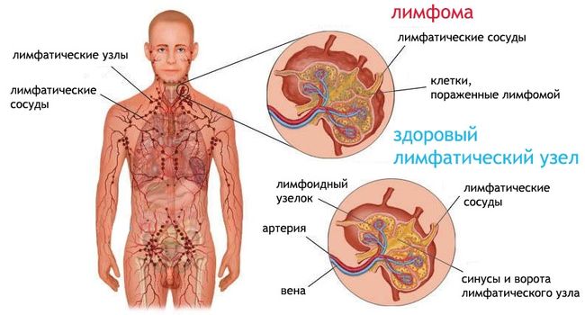 Лимфома и здоровый лимфатический узел