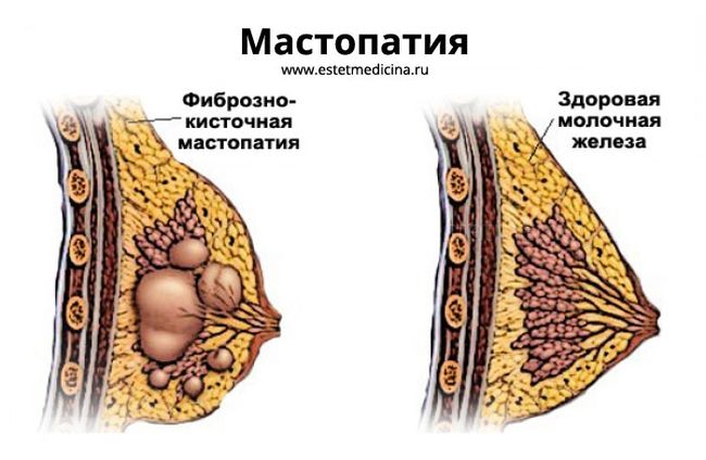 Мастопатия молочных желез – это общее название доброкачественных опухолей, которые возникают в груди