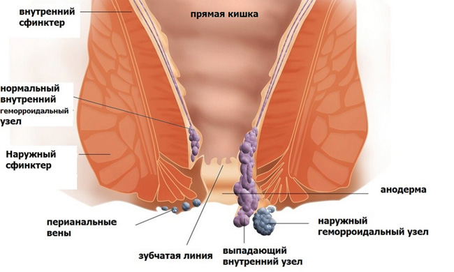 Геморрой – крайне неприятное заболевание, которое влечет за собой болевые ощущения в области анального отверстия, а также кровотечение и зуд
