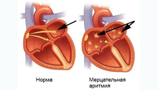 Мерцательная аритмия - одно из самых часто встречающихся явлений нарушения ритма сердца