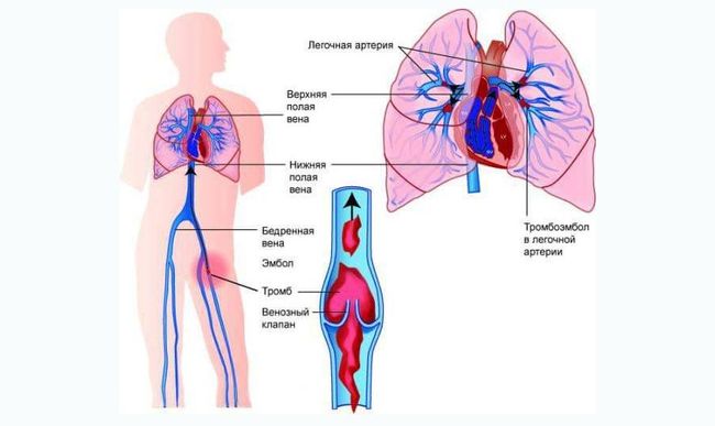 Большую опасность представляет значительный рост риска закупорки вен тромбами, которые могут попасть в циркулирующую кровь
