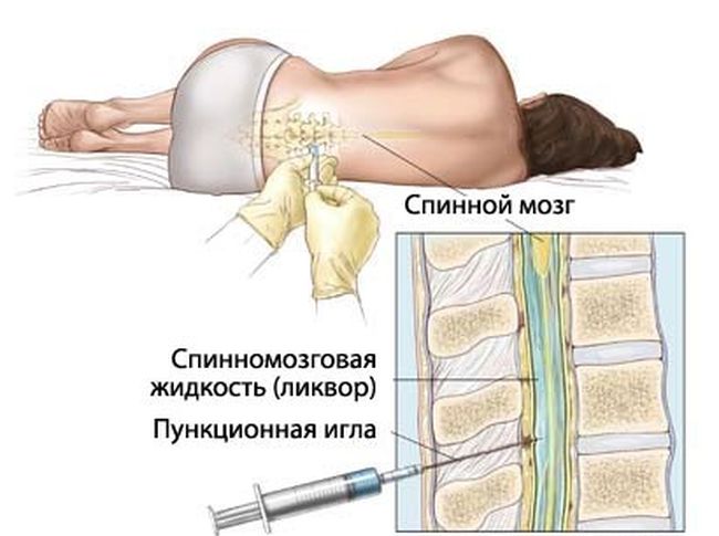 После того, как симптомы менингита были обнаружены, больного направляют на спинномозговую пункцию