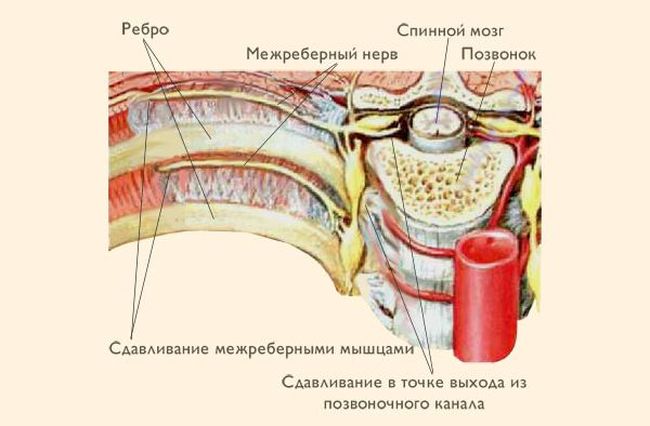 Межреберная невралгия затрагивает нервную систему сопровождается болями в груди