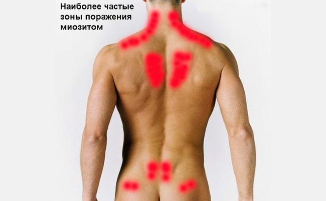 Главные зоны поражения миозитом