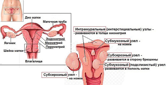 Узлы миомы матки вначале возникают в толще миометрия