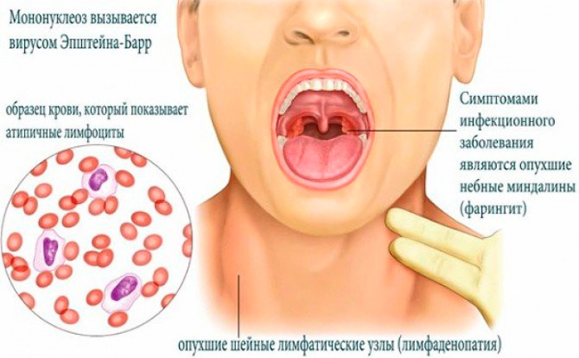 Данным заболеванием в основном болеют люди до 40 лет, после перенесенной болезни у всех вырабатывается стойкий иммунитет