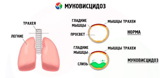 Муковисцидоз - это заболевание, которое нарушает работу многих органов внутри организма.