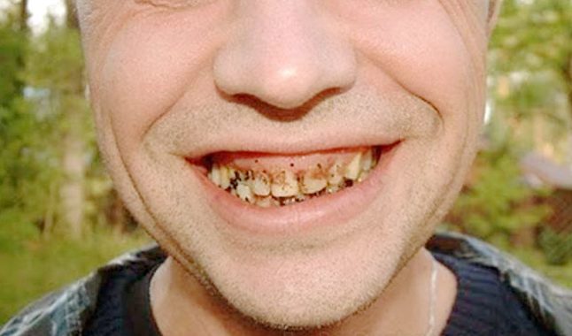 Плохой уход за полостью рта, может стать причиной несвежего дыхания