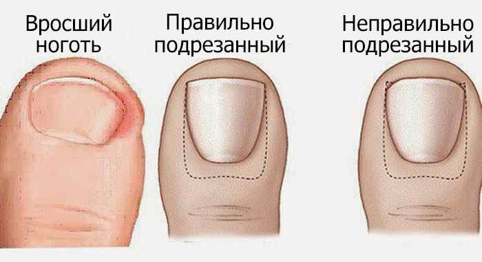 Чтобы избежать появления такого неприятного заболевания, как вросший ноготь, следует правильно подрезать ногти на ногах, как это показано на картинке