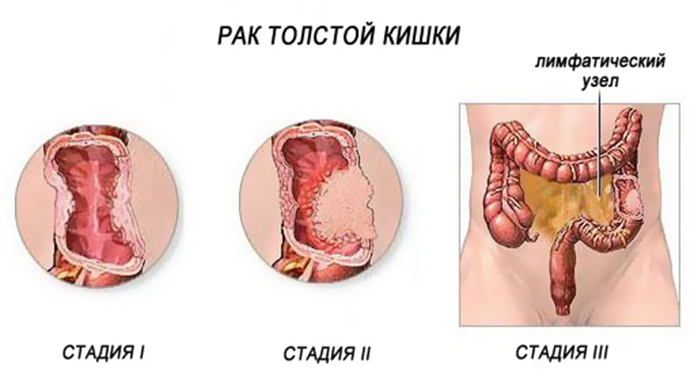 Распространение и локализация рака толстой кишки в 1, 2, 3 стадиях.