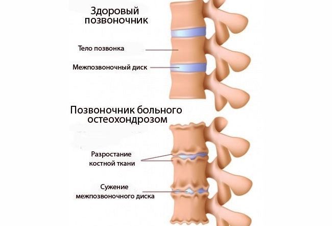 Остеохондроз - самое распространенное заболевание позвоночника