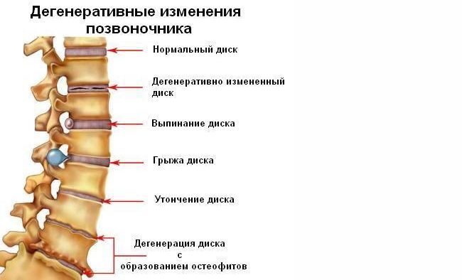 Дегенеративные изменения позвоночника во время остеохондроза